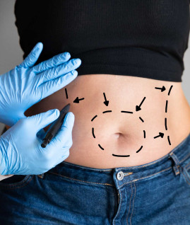 Yağ Aldırma (Liposuction)