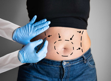 Yağ Aldırma (Liposuction)